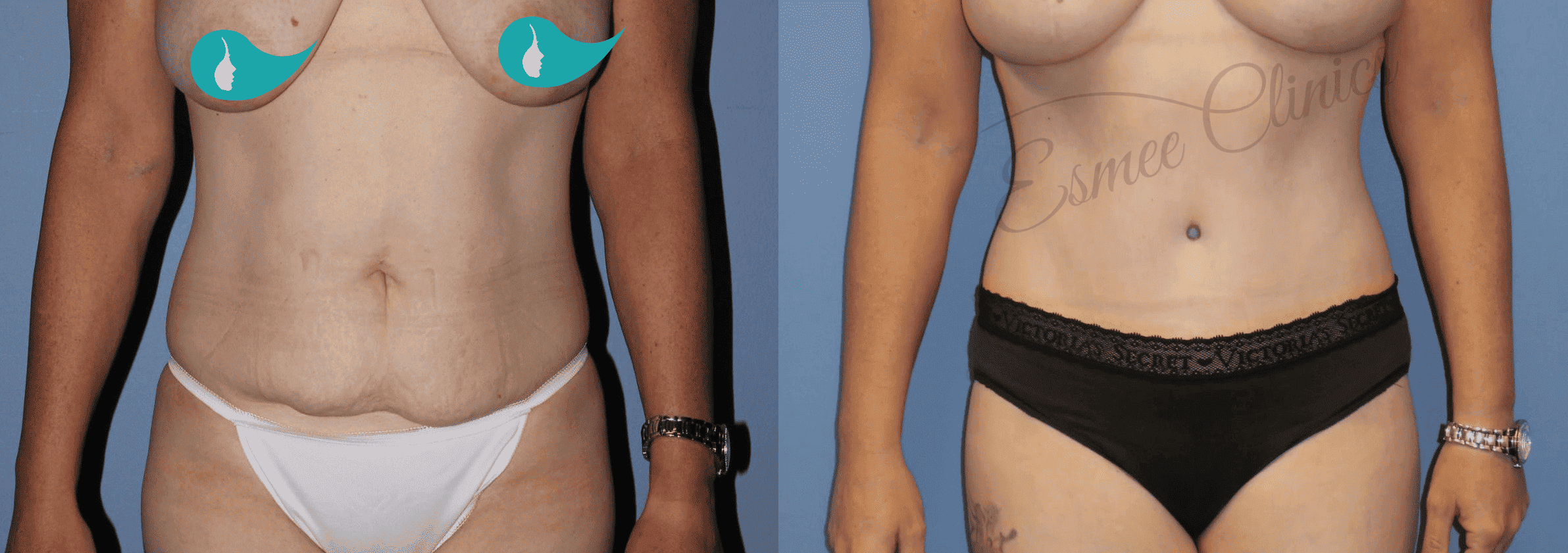 Before and After img